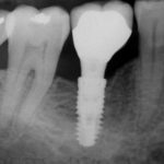 Comment se passe l’entretien d’un implant dentaire ?