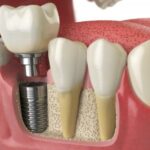 Les implants dentaires sont-ils pris en charge par la Sécurité Sociale ?