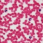 découvrez des informations essentielles sur la leucémie, une maladie du sang, ses symptômes, traitements et avancées médicales pour mieux comprendre et agir.