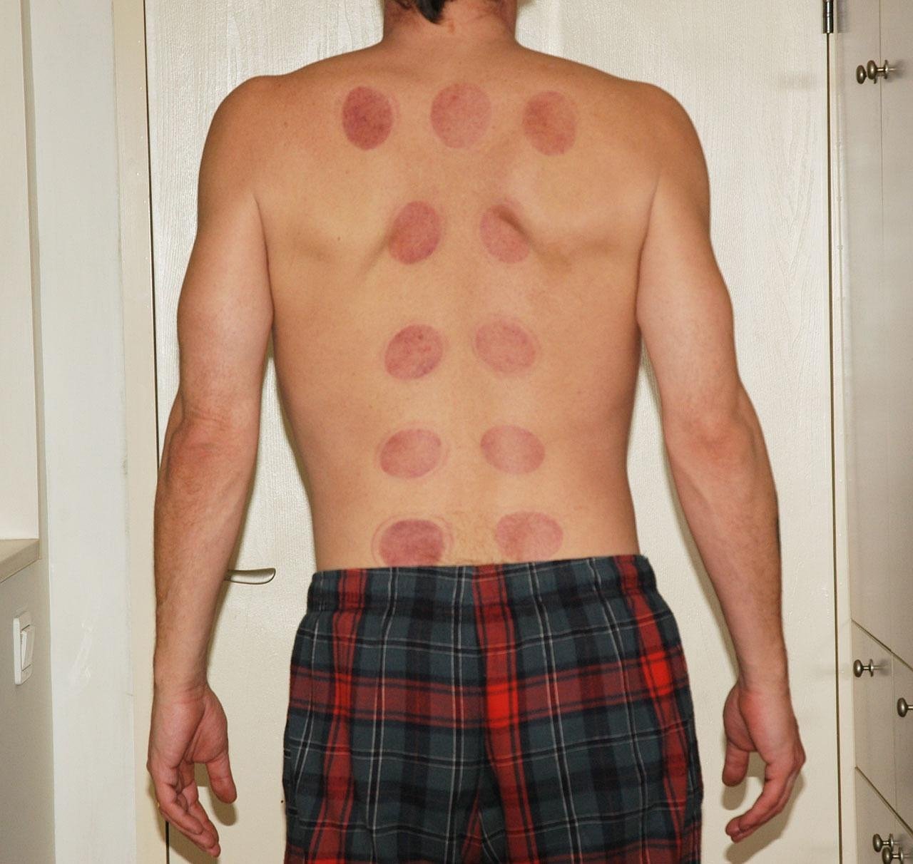 découvrez les bienfaits de l'acupuncture, une pratique traditionnelle chinoise qui favorise l'équilibre du corps et de l'esprit pour améliorer votre bien-être.