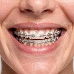 Comparatif des mutuelles pour orthodontie adulte sans plafond